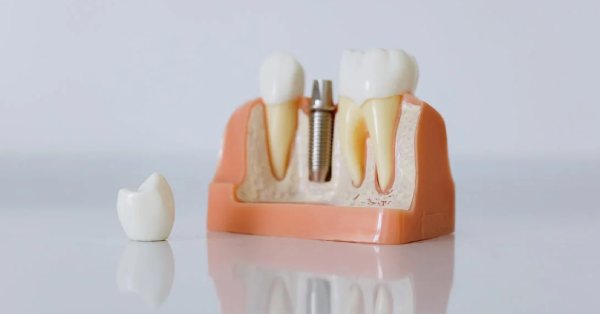 How Long Does It Take to Get Dental Implants in Garland?
